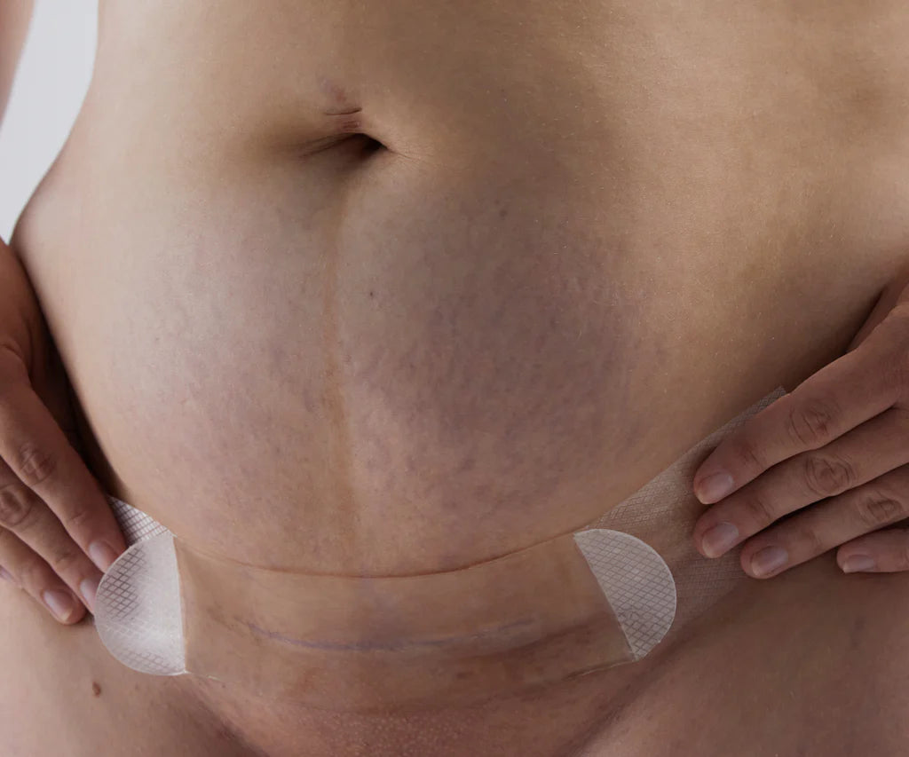 BARE MUM Silicone Gel Scar Strips